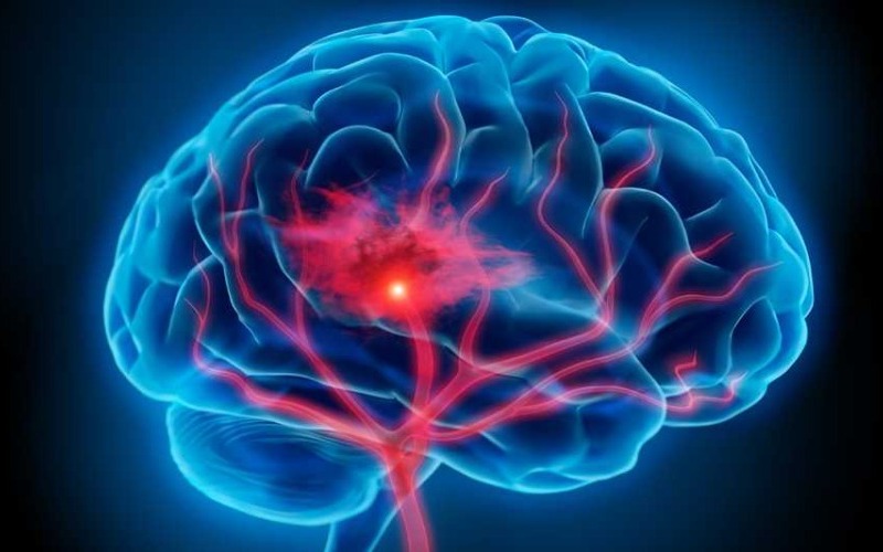 1140-brain-in-stroke-esp-d16969.jpg