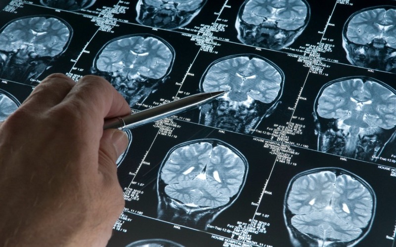 alzheimer-ressonancia-magnetica-1216-1400x800-b586e1.jpg
