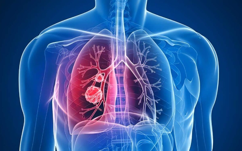 cancer-pulmon-0de4a4.jpg