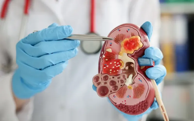 cancer-renal-1-cba7e4.webp