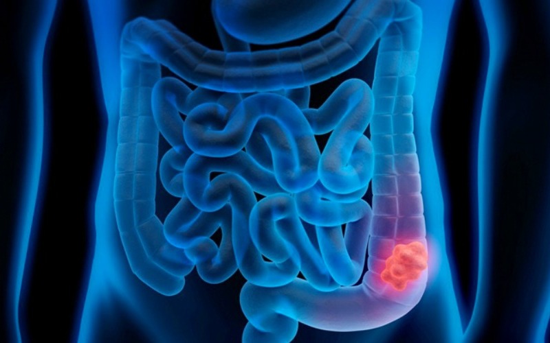 colon-95b2b8.jpg