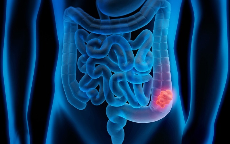 colorectalcancer-731345.jpg