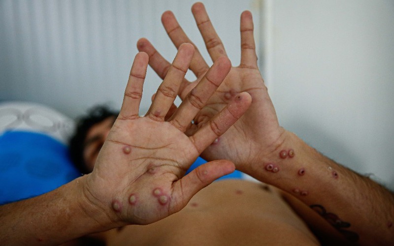 Cerca de 97.800 casos y 1.735 muertes por mpox en África desde principios de 2024