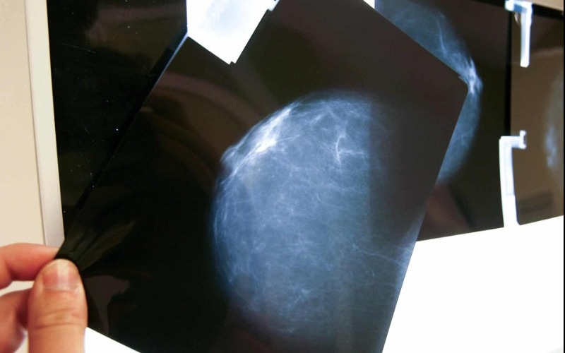 expertos-alertan-sobre-la-falta-de-registros-de-cancer-de-mama-en-america-latina-1-bc32e8.jpg