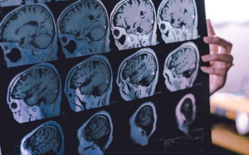 frontotemporaldementia-1024x576-0bddcb.jpg
