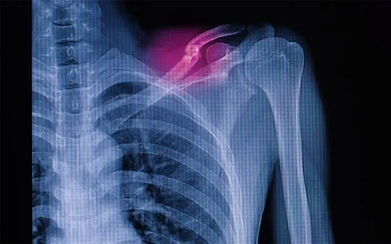 hong-kong-desarrolla-nanocemento-oseo-para-reparacion-de-fracturas-76204fcd-focus-min0.06-0.62-1200-675-70b580.webp