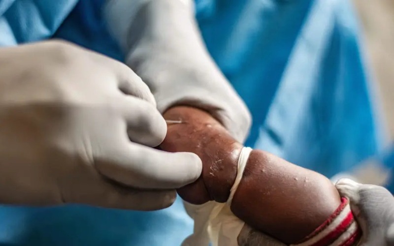 la-union-africana-confirma-mas-de-540-muertos-y-18-700-casos-de-mpox-en-africa-desde-principios-de-ao-a25e75.jpg