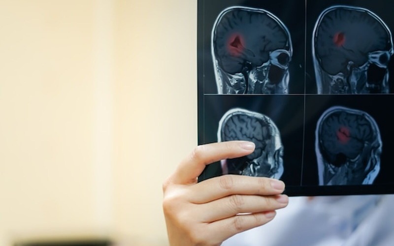 mano-mujer-radiologo-que-sostiene-pelicula-cerebral-mri-ver-diagnostico-e-informe-medical-c-42401-37-82159e.jpg
