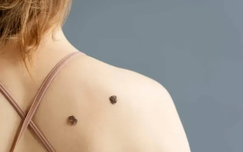 melanoma-caracteristicas-089c17.webp