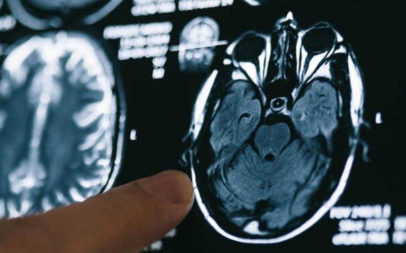 proteina-del-cerebro-retrasa-progresion-del-alzheimer-750x375-61bdf9.jpg