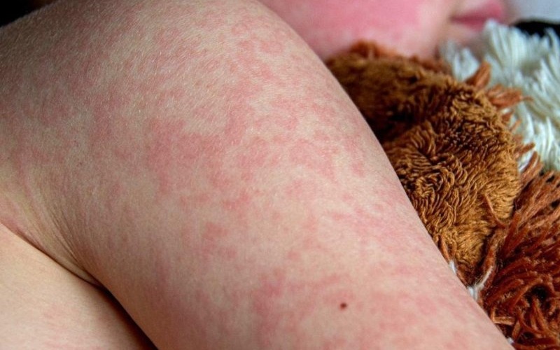 sarampion-la-varicela-y-el-dengue-220bda.jpg