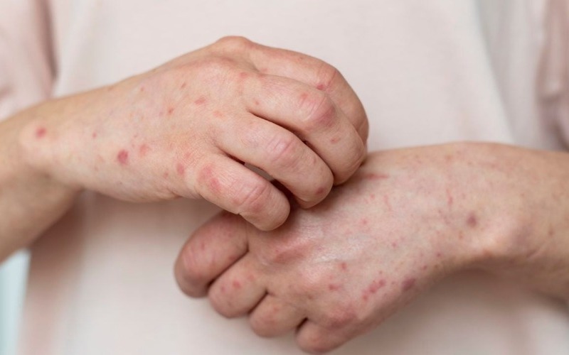 skin-allergy-person-s-arm-1280x720-a4d887.jpg