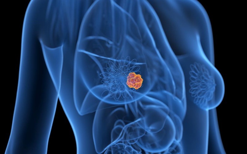 una-ilustracion-de-cancer-de-mama-3457d0.jpeg
